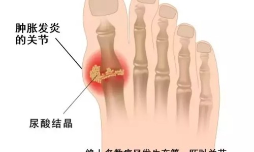 痛风病人吃玉米可以吗